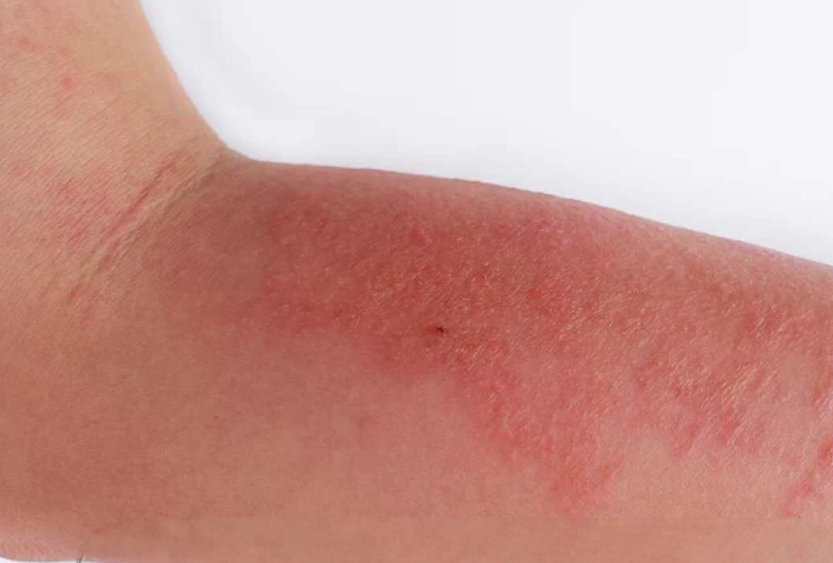 Atopische dermatitis – Constitutioneel eczeem & symptomen